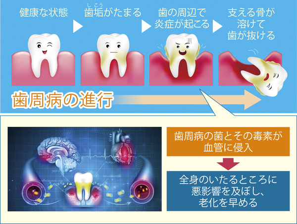 歯周病は口の中だけの問題ではない