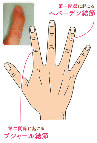 指が曲がって痛む「ヘバーデン結節・ブシャール結節」ってどんな病気？ 形成外科医 監修